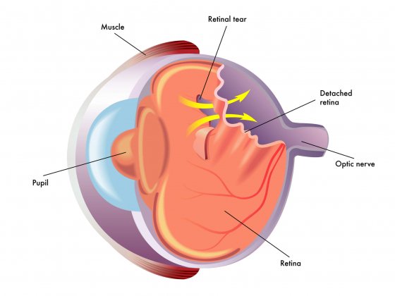 showing retinal detachment on an image of the eye